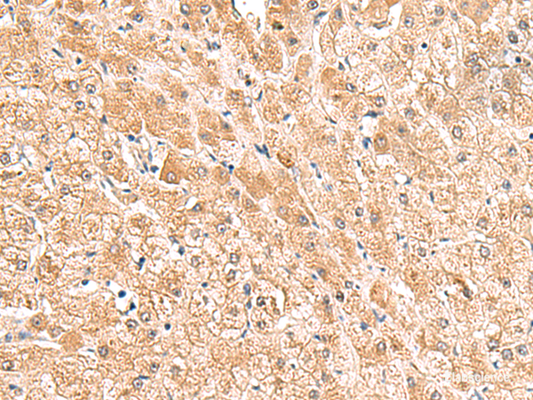 Immunohistochemistry of paraffin-embedded Human liver cancer tissue  using TRUB1 Polyclonal Antibody at dilution of 1:85(×200)