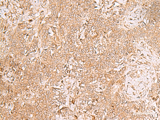 Immunohistochemistry of paraffin-embedded Human ovarian cancer tissue  using GMPPB Polyclonal Antibody at dilution of 1:50(×200)