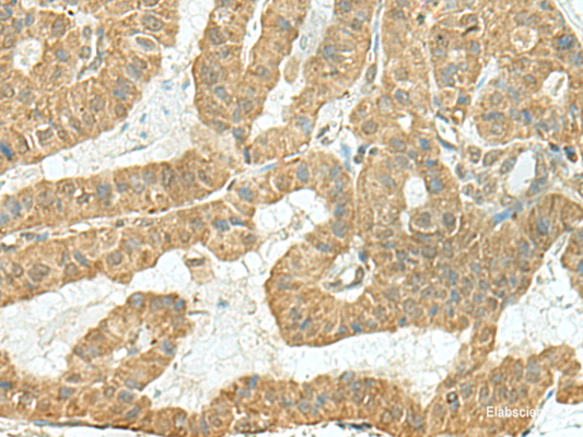 Immunohistochemistry of paraffin-embedded Human thyroid cancer tissue  using TENT5C Polyclonal Antibody at dilution of 1:110(×200)