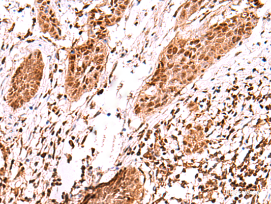 Immunohistochemistry of paraffin-embedded Human esophagus cancer tissue  using AK9 Polyclonal Antibody at dilution of 1:60(×200)