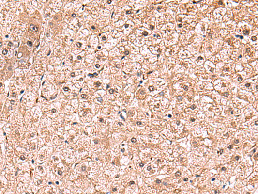 Immunohistochemistry of paraffin-embedded Human liver cancer tissue  using RUSC1 Polyclonal Antibody at dilution of 1:90(×200)
