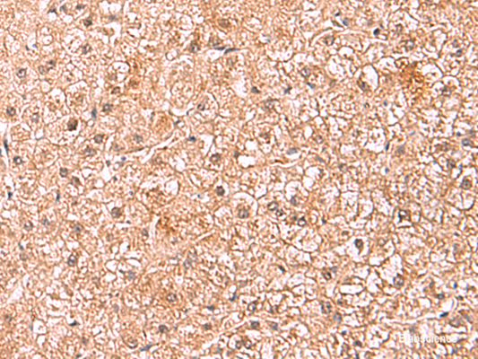 Immunohistochemistry of paraffin-embedded Human liver cancer tissue  using ASTN2 Polyclonal Antibody at dilution of 1:80(×200)