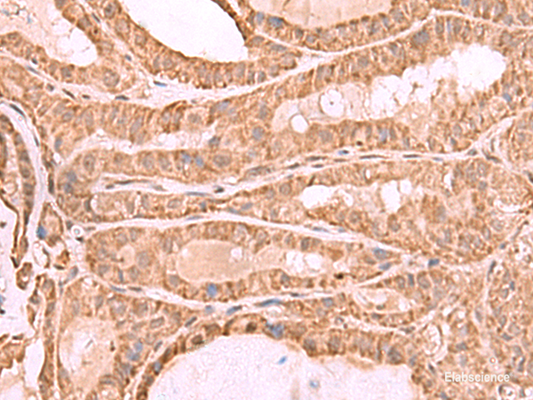 Immunohistochemistry of paraffin-embedded Human thyroid cancer tissue  using CDC20 Polyclonal Antibody at dilution of 1:70(×200)