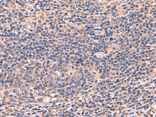 Immunohistochemistry of paraffin-embedded Human cervical cancer tissue  using AHCYL1 Polyclonal Antibody at dilution of 1:70(×200)