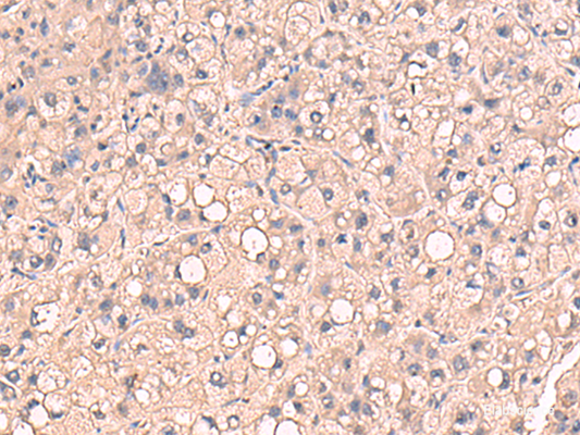 Immunohistochemistry of paraffin-embedded Human liver cancer tissue  using RIOK1 Polyclonal Antibody at dilution of 1:80(×200)