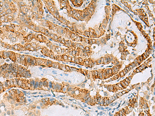 Immunohistochemistry of paraffin-embedded Human thyroid cancer tissue  using FARP2 Polyclonal Antibody at dilution of 1:70(×200)