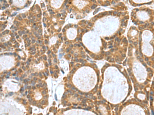 Immunohistochemistry of paraffin-embedded Human thyroid cancer tissue  using KANSL1L Polyclonal Antibody at dilution of 1:80(×200)