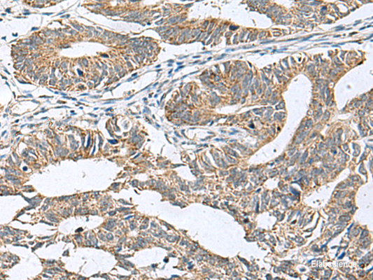 Immunohistochemistry of paraffin-embedded Human colorectal cancer tissue  using DPY19L3 Polyclonal Antibody at dilution of 1:120(×200)