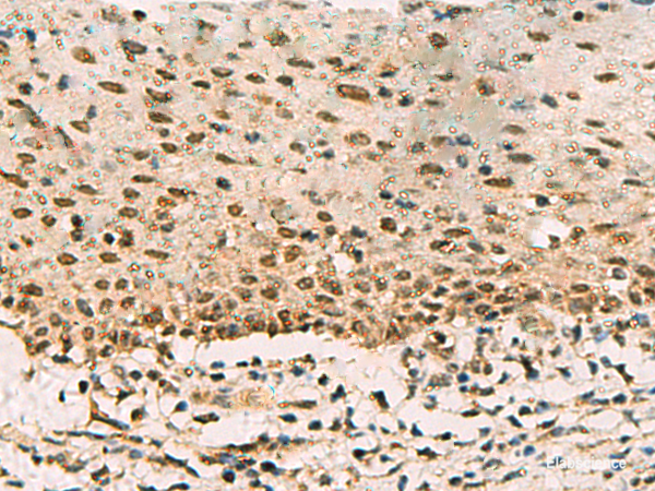 Immunohistochemistry of paraffin-embedded Human cervical cancer tissue  using PHF5A Polyclonal Antibody at dilution of 1:90(×200)