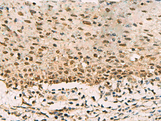 Immunohistochemistry of paraffin-embedded Human cervical cancer tissue  using PHF5A Polyclonal Antibody at dilution of 1:90(×200)
