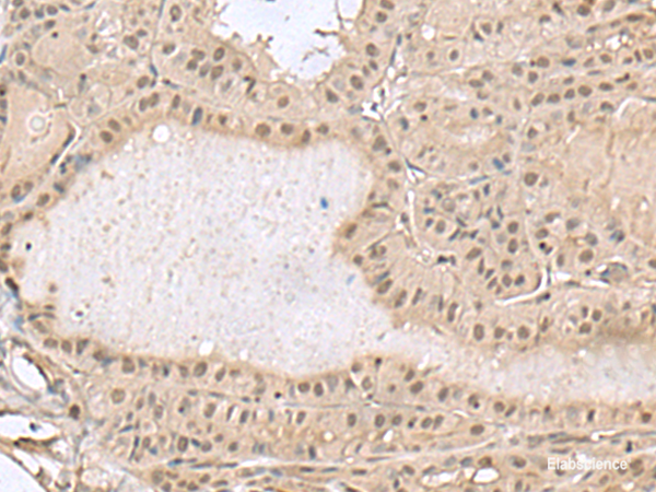 Immunohistochemistry of paraffin-embedded Human thyroid cancer tissue  using PCLAF Polyclonal Antibody at dilution of 1:50(×200)