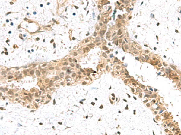 Immunohistochemistry of paraffin-embedded Human breast cancer tissue  using ELOC Polyclonal Antibody at dilution of 1:55(×200)