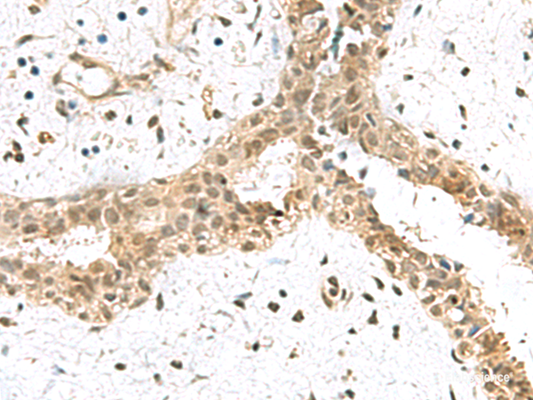 Immunohistochemistry of paraffin-embedded Human breast cancer tissue  using ELOC Polyclonal Antibody at dilution of 1:55(×200)