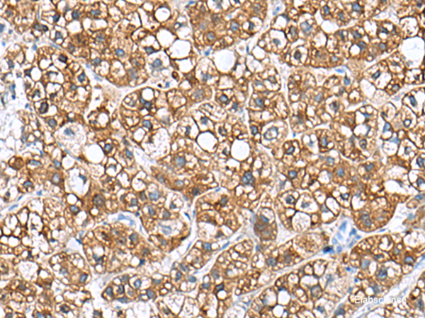 Immunohistochemistry of paraffin-embedded Human liver cancer tissue  using PHLDA3 Polyclonal Antibody at dilution of 1:110(×200)