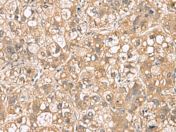 Immunohistochemistry of paraffin-embedded Human liver cancer tissue  using PTPRS Polyclonal Antibody at dilution of 1:110(×200)