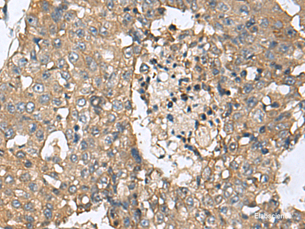 Immunohistochemistry of paraffin-embedded Human liver cancer tissue  using CD59 Polyclonal Antibody at dilution of 1:160(×200)