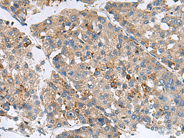 Immunohistochemistry of paraffin-embedded Human liver cancer tissue  using MED31 Polyclonal Antibody at dilution of 1:100(×200)