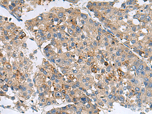 Immunohistochemistry of paraffin-embedded Human liver cancer tissue  using MED31 Polyclonal Antibody at dilution of 1:100(×200)