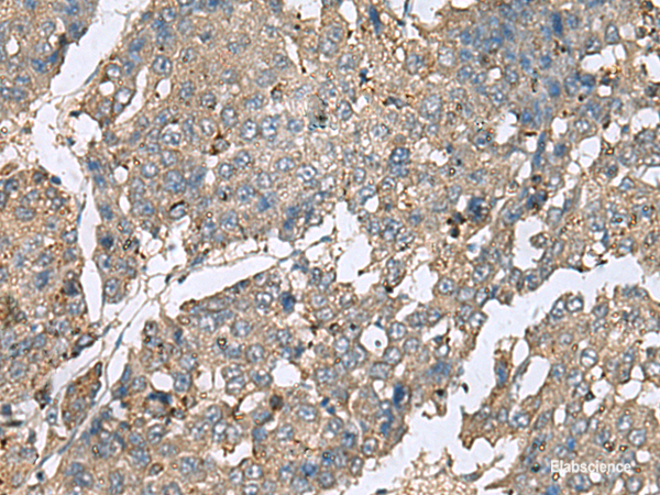 Immunohistochemistry of paraffin-embedded Human liver cancer tissue  using PLA2G2A Polyclonal Antibody at dilution of 1:50(×200)