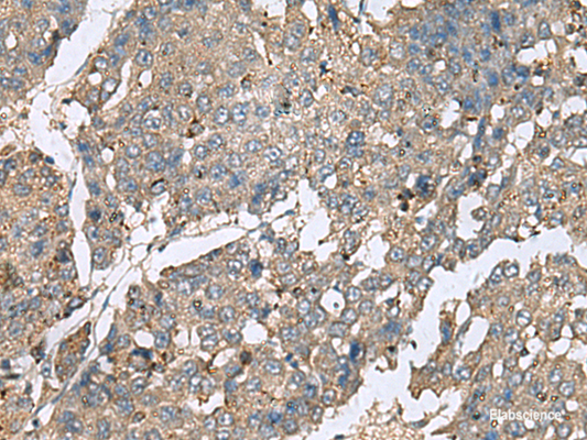 Immunohistochemistry of paraffin-embedded Human liver cancer tissue  using PLA2G2A Polyclonal Antibody at dilution of 1:50(×200)