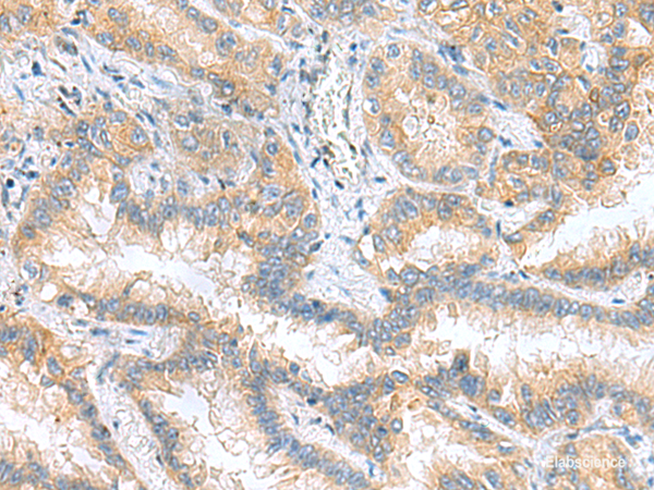 Immunohistochemistry of paraffin-embedded Human lung cancer tissue  using RPS16 Polyclonal Antibody at dilution of 1:60(×200)