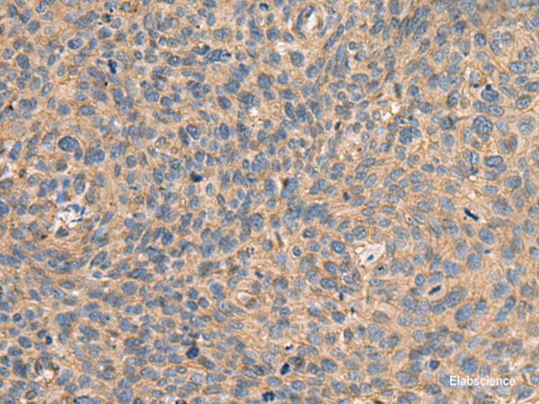 Immunohistochemistry of paraffin-embedded Human cervical cancer tissue  using AHNAK Polyclonal Antibody at dilution of 1:50(×200)