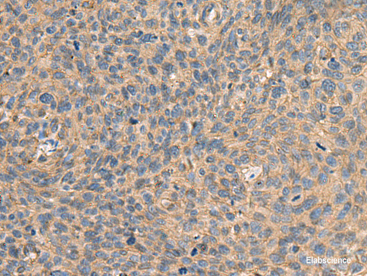Immunohistochemistry of paraffin-embedded Human cervical cancer tissue  using AHNAK Polyclonal Antibody at dilution of 1:50(×200)