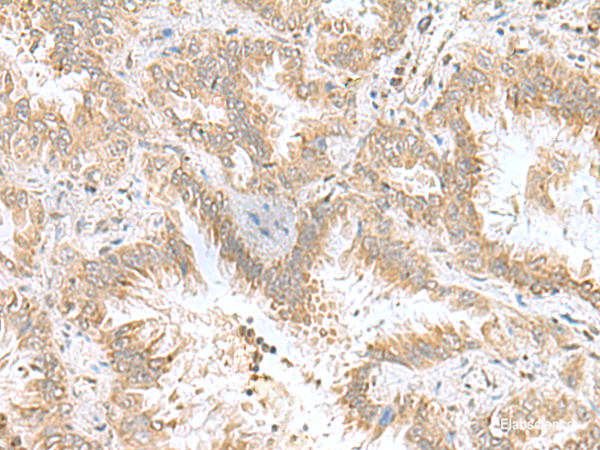 Immunohistochemistry of paraffin-embedded Human lung cancer tissue  using CPLX3 Polyclonal Antibody at dilution of 1:55(×200)