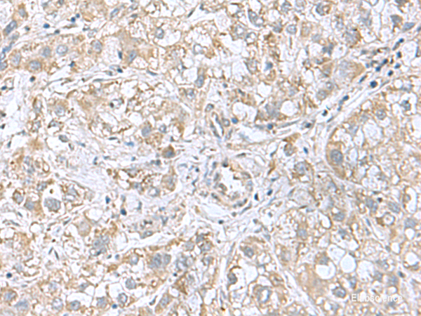 Immunohistochemistry of paraffin-embedded Human liver cancer tissue  using CGB5 Polyclonal Antibody at dilution of 1:55(×200)