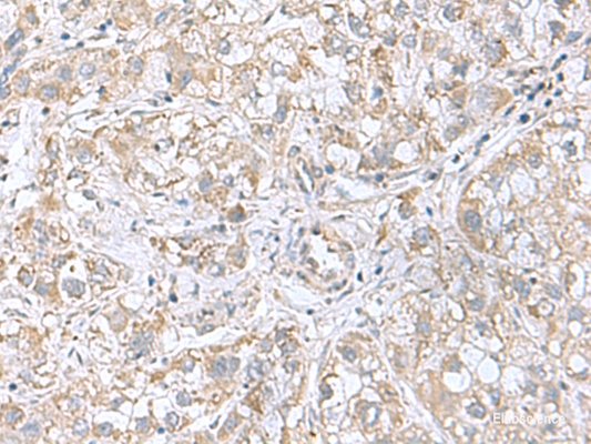 Immunohistochemistry of paraffin-embedded Human liver cancer tissue  using CGB5 Polyclonal Antibody at dilution of 1:55(×200)