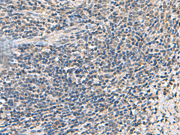 Immunohistochemistry of paraffin-embedded Human cervical cancer tissue  using ATP5F1D Polyclonal Antibody at dilution of 1:55(×200)