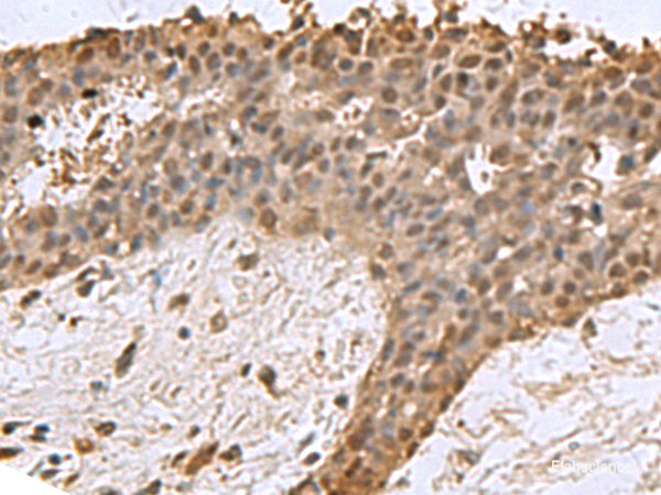 Immunohistochemistry of paraffin-embedded Human breast cancer tissue  using DCTPP1 Polyclonal Antibody at dilution of 1:85(×200)