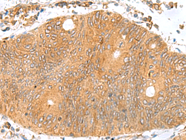 Immunohistochemistry of paraffin-embedded Human colorectal cancer tissue  using TXNDC12 Polyclonal Antibody at dilution of 1:70(×200)