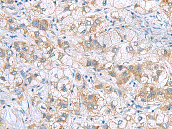 Immunohistochemistry of paraffin-embedded Human liver cancer tissue  using GCSH Polyclonal Antibody at dilution of 1:60(×200)