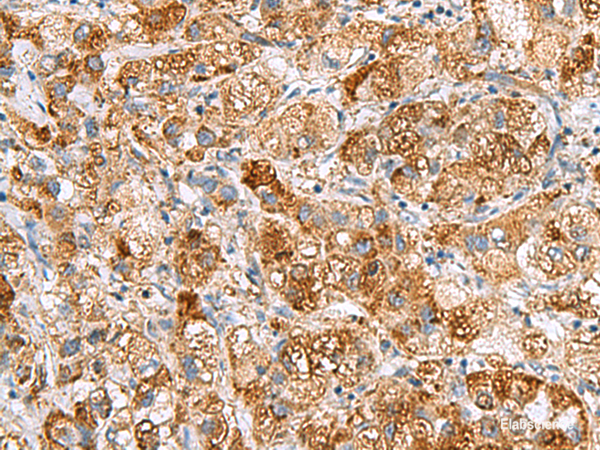 Immunohistochemistry of paraffin-embedded Human liver cancer tissue  using NMU Polyclonal Antibody at dilution of 1:80(×200)