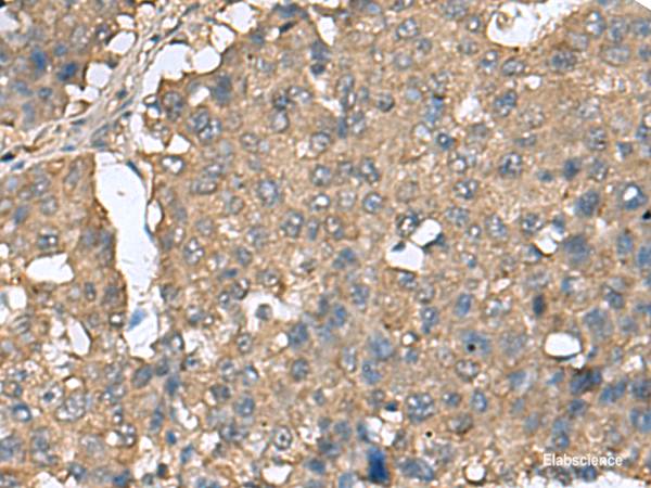 Immunohistochemistry of paraffin-embedded Human liver cancer tissue  using EIF4A2 Polyclonal Antibody at dilution of 1:65(×200)