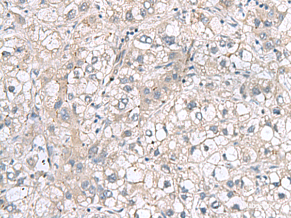 Immunohistochemistry of paraffin-embedded Human liver cancer tissue  using RNF208 Polyclonal Antibody at dilution of 1:65(×200)