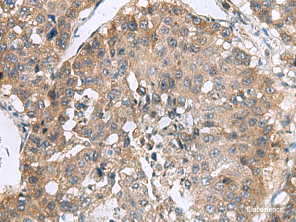 Immunohistochemistry of paraffin-embedded Human liver cancer tissue  using RPL18 Polyclonal Antibody at dilution of 1:70(×200)