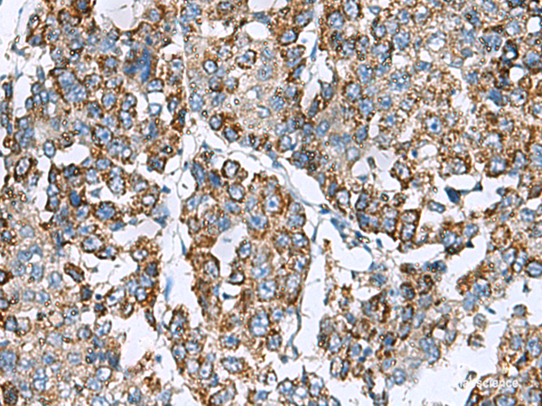 Immunohistochemistry of paraffin-embedded Human liver cancer tissue  using PRELID3B Polyclonal Antibody at dilution of 1:90(×200)