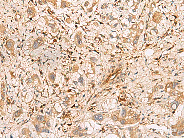 Immunohistochemistry of paraffin-embedded Human liver cancer tissue  using PLCB2 Polyclonal Antibody at dilution of 1:60(×200)