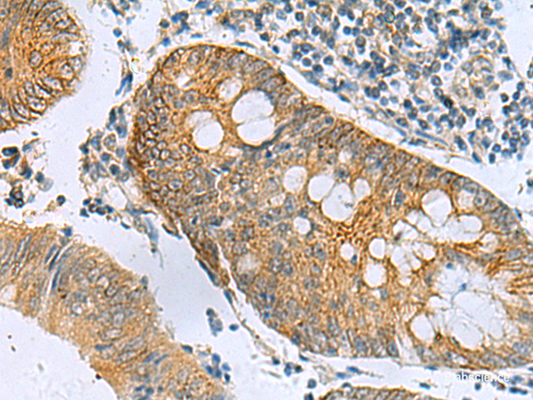 Immunohistochemistry of paraffin-embedded Human colorectal cancer tissue  using GUCA1A Polyclonal Antibody at dilution of 1:105(×200)