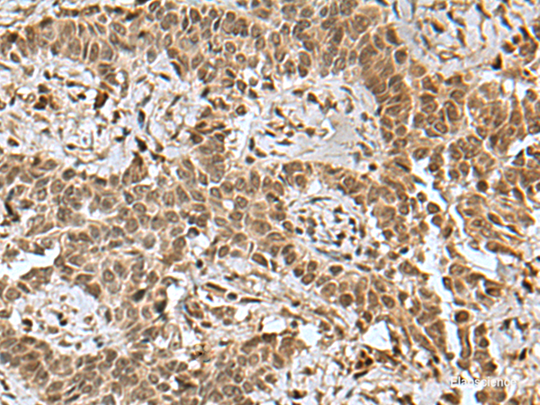 Immunohistochemistry of paraffin-embedded Human ovarian cancer tissue  using BCL7B Polyclonal Antibody at dilution of 1:85(×200)