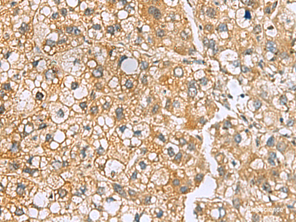 Immunohistochemistry of paraffin-embedded Human liver cancer tissue  using MRPL22 Polyclonal Antibody at dilution of 1:50(×200)