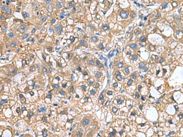Immunohistochemistry of paraffin-embedded Human liver cancer tissue  using IGLL1 Polyclonal Antibody at dilution of 1:65(×200)