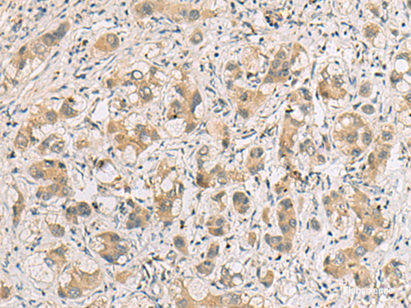 Immunohistochemistry of paraffin-embedded Human liver cancer tissue  using RTP4 Polyclonal Antibody at dilution of 1:80(×200)