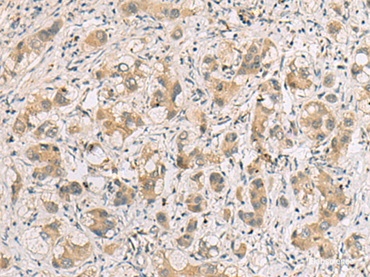 Immunohistochemistry of paraffin-embedded Human liver cancer tissue  using RTP4 Polyclonal Antibody at dilution of 1:80(×200)