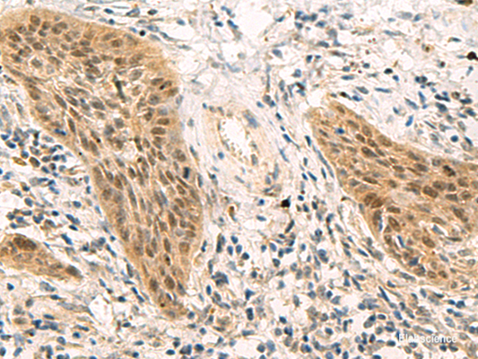 Immunohistochemistry of paraffin-embedded Human esophagus cancer tissue  using PSME1 Polyclonal Antibody at dilution of 1:50(×200)