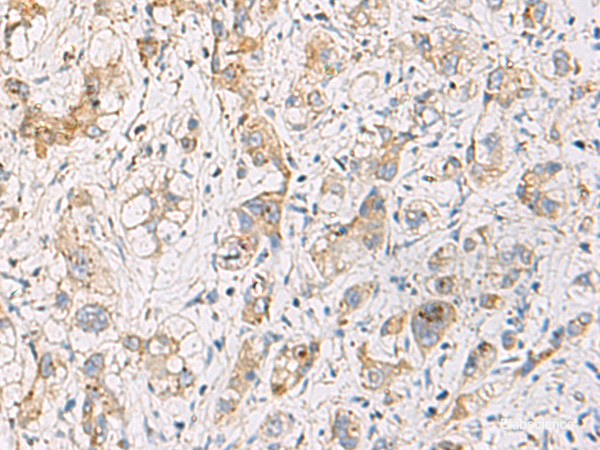 Immunohistochemistry of paraffin-embedded Human liver cancer tissue  using FYCO1 Polyclonal Antibody at dilution of 1:110(×200)