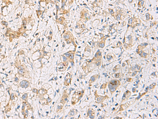 Immunohistochemistry of paraffin-embedded Human liver cancer tissue  using FYCO1 Polyclonal Antibody at dilution of 1:110(×200)