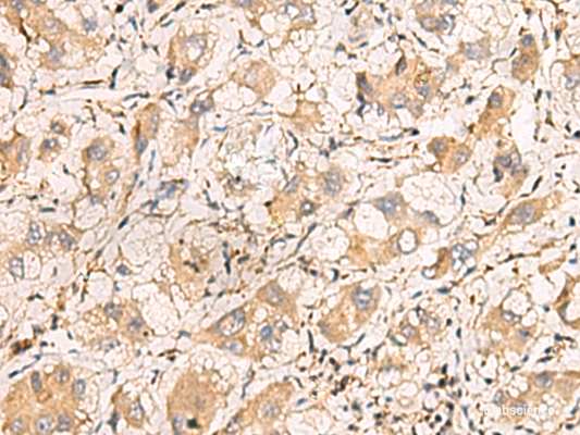 Immunohistochemistry of paraffin-embedded Human liver cancer tissue  using TNNT1 Polyclonal Antibody at dilution of 1:75(×200)